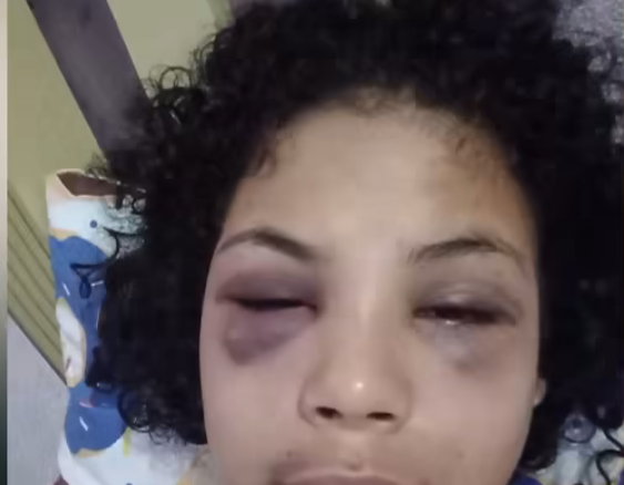 Lorena com hematomas