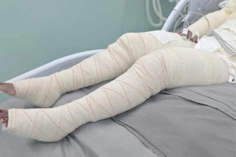 Vítima teve queimaduras graves em diversas partes do corpo e encontra-se internada
